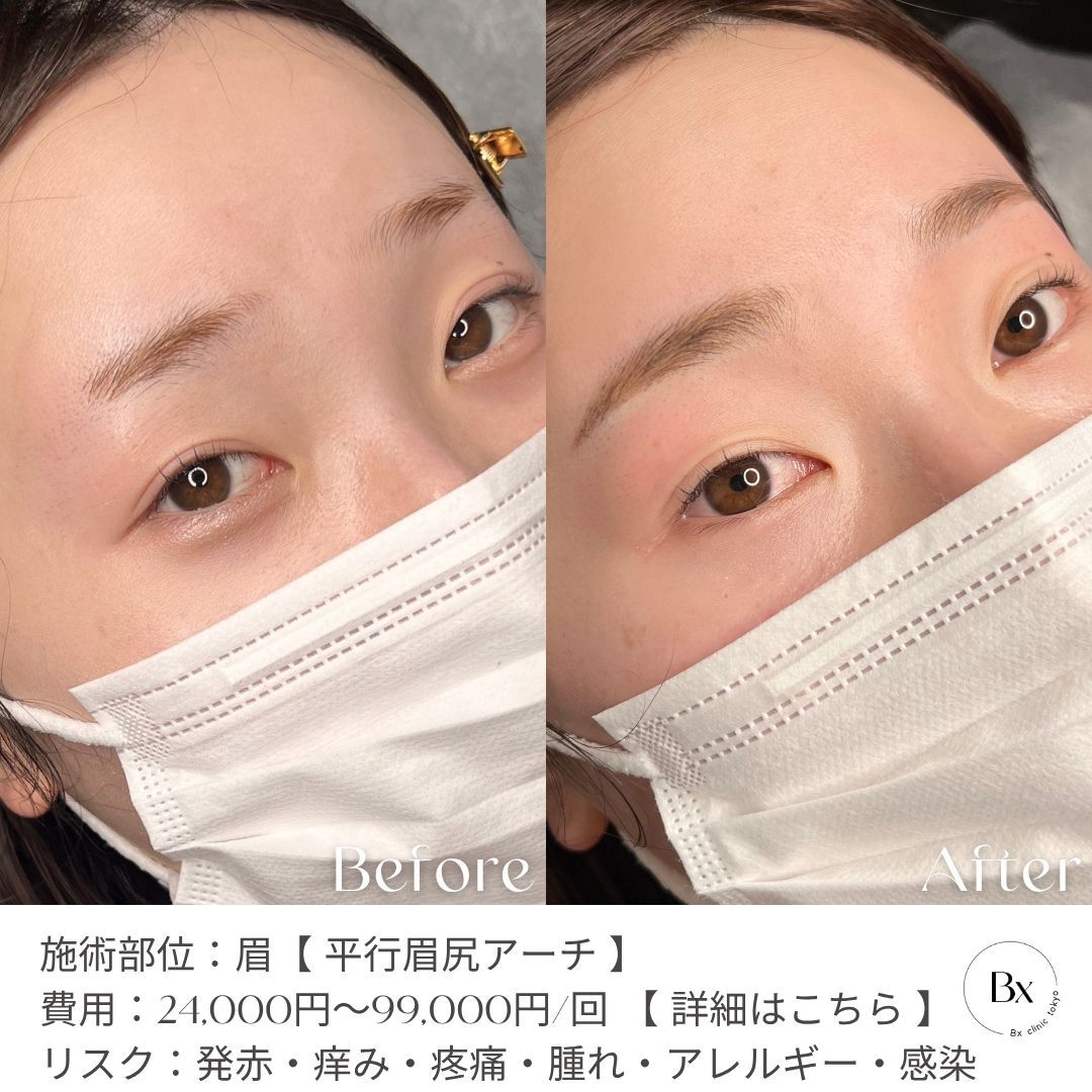 アフター