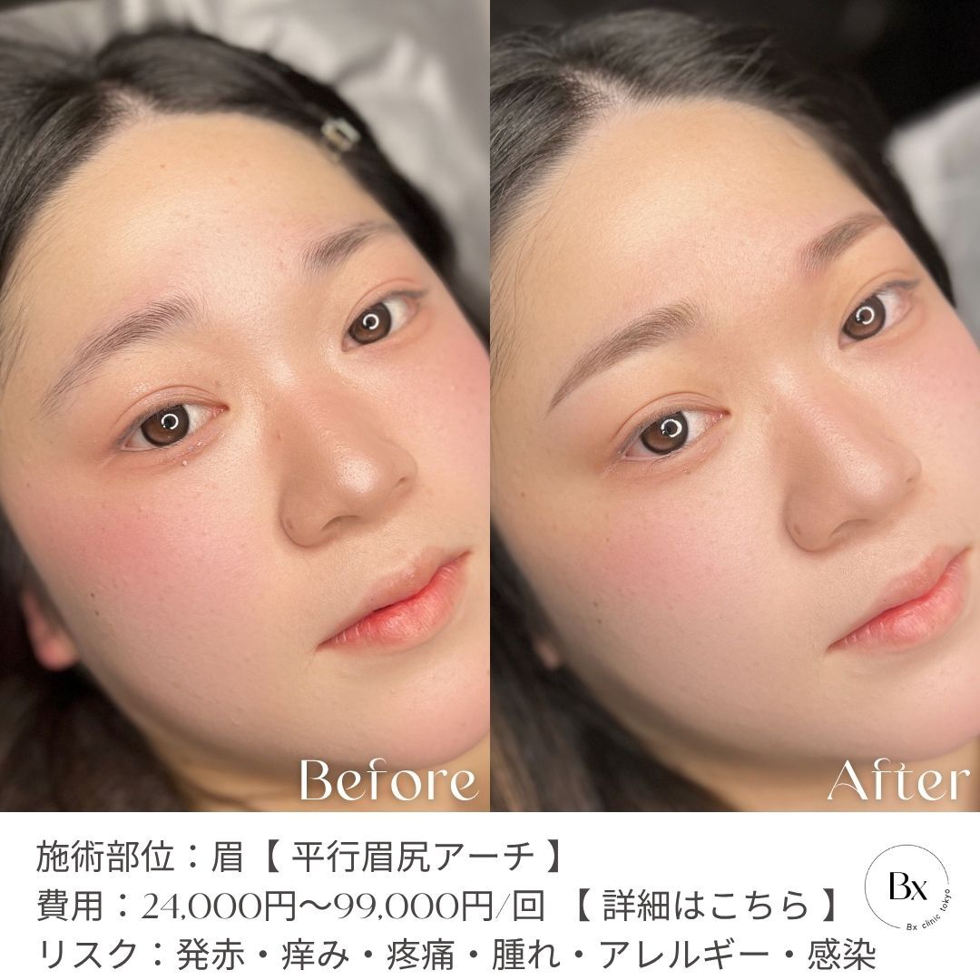 アフター